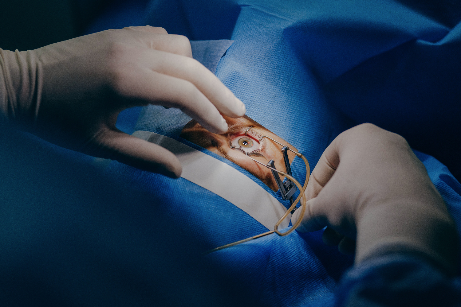 Cataract Surgery