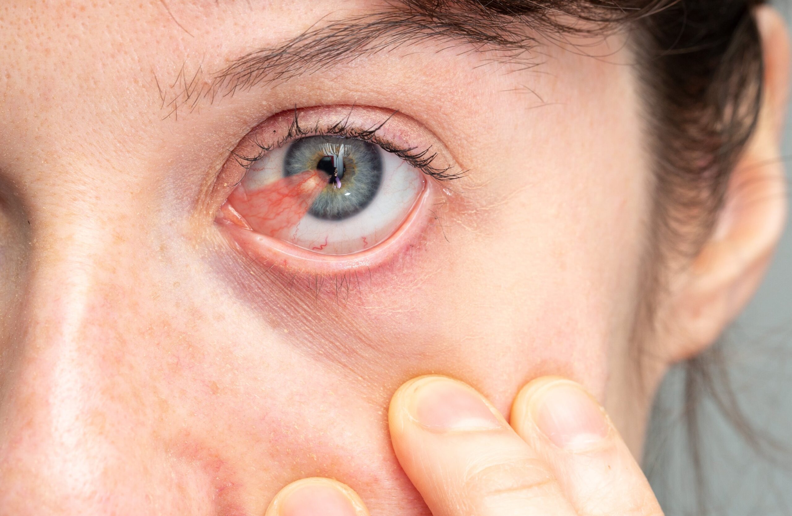 Pterygium Surgery