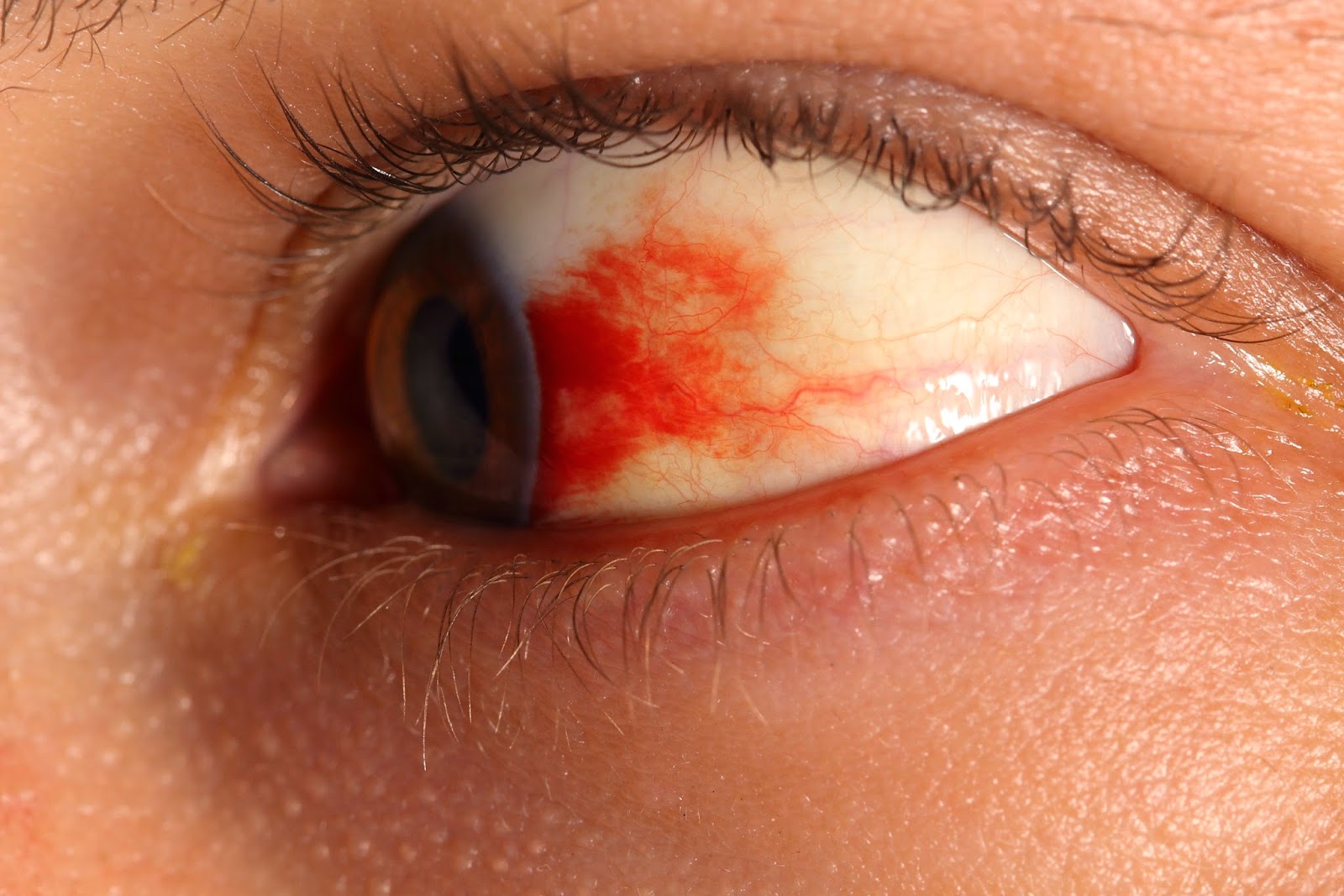 Diabetic Retinopathy Treatment