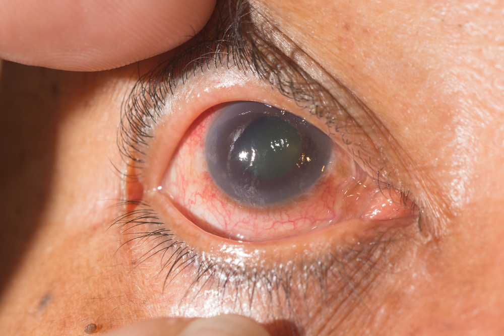Glaucoma Management